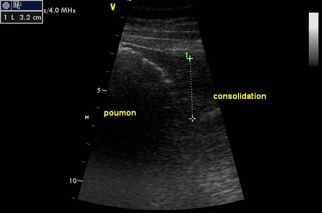 Consolidation pulmonaire chez un cheval atteint du syndrome de Cushing et souffrant d'une pneumonie sévère.