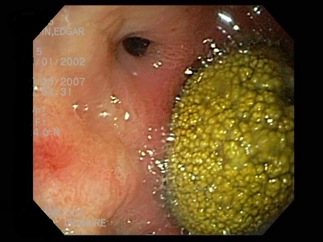 Calcul urinaire dans la vessie dans un cheval présenté pour de la difficulté à uriner (polakyurie, strangurie) et du sang dans les urines (hématurie). Les symptômes apparaissaient le plus souvent directement après l’exercice. 