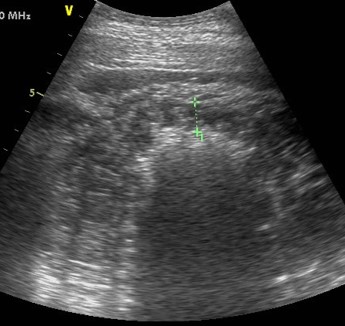 Echographie de l'abdomen d'un cheval avec un torsion de colon. La paroi du gros intestin est extrêmement épaisse (entre les croix vertes).
