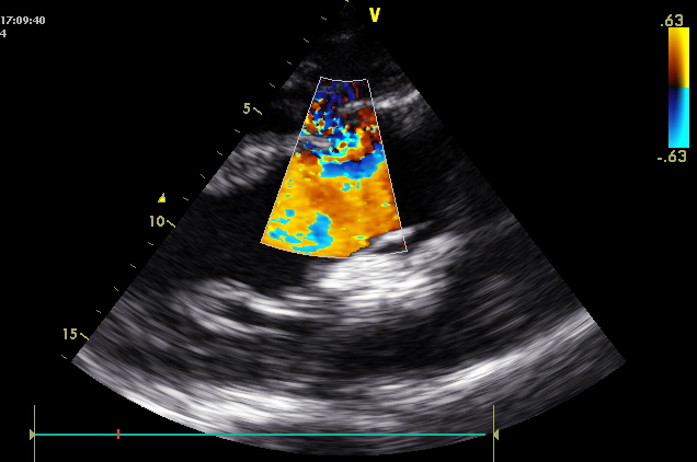 Communication de 1,3 cm entre le ventricule gauche et le ventricule droit à travers le septum inter-ventriculaire. 